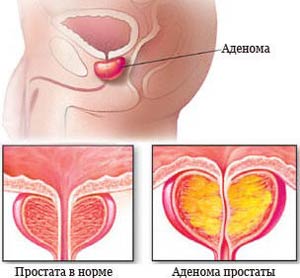 prostatita cu adenom de prostată hematuria semnifica