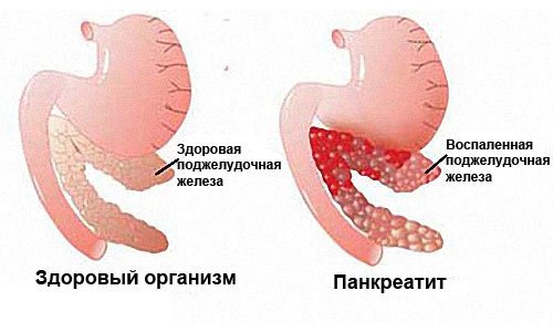 Панкреатин Болезнь Симптомы