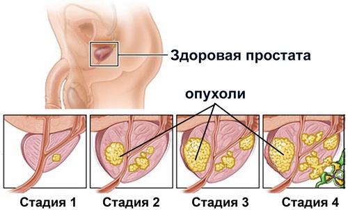 prostatita cu adenom de prostată tratamentul prostatitei în alishekh