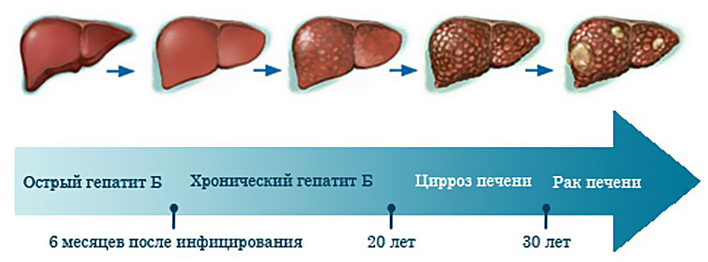 лечение гепатита В в москве